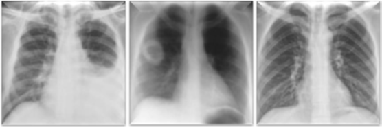 Chest x-ray images showing 2 examples of pulmonary abnormalities (left: pleural effusion, middle: cavitary lung lesion right lung), and  normal lung image (right).